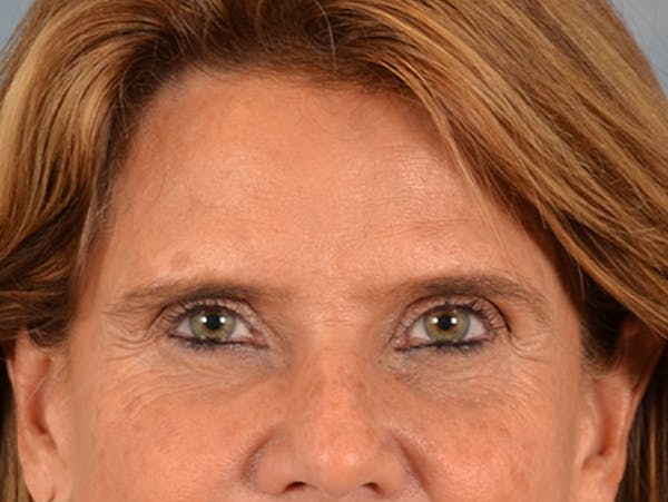 Eyelid Lift Before & After Gallery - Patient 635760 - Image 1