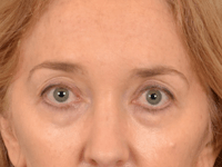 Eyelid Lift Before & After Gallery - Patient 120561 - Image 1