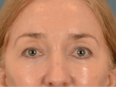 Eyelid Lift Before & After Gallery - Patient 120561 - Image 2