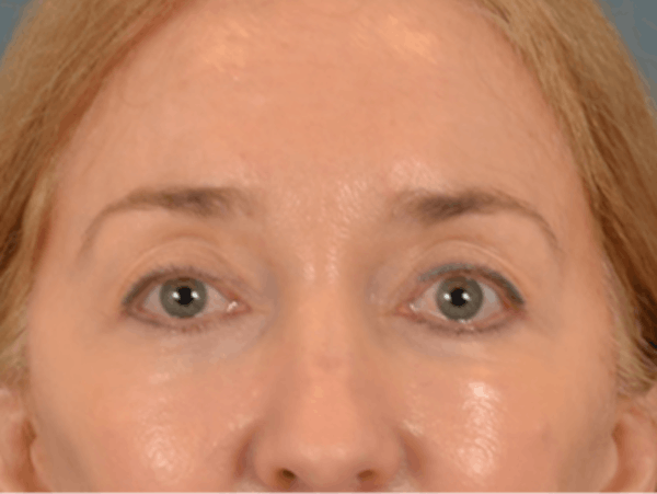 Eyelid Lift Before & After Gallery - Patient 120561 - Image 2