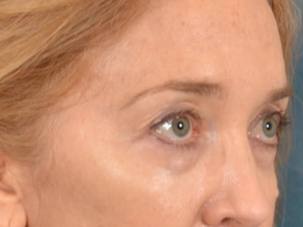 Eyelid Lift Before & After Gallery - Patient 120561 - Image 3