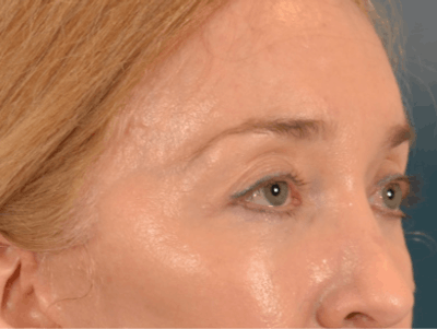 Eyelid Lift Before & After Gallery - Patient 120561 - Image 4