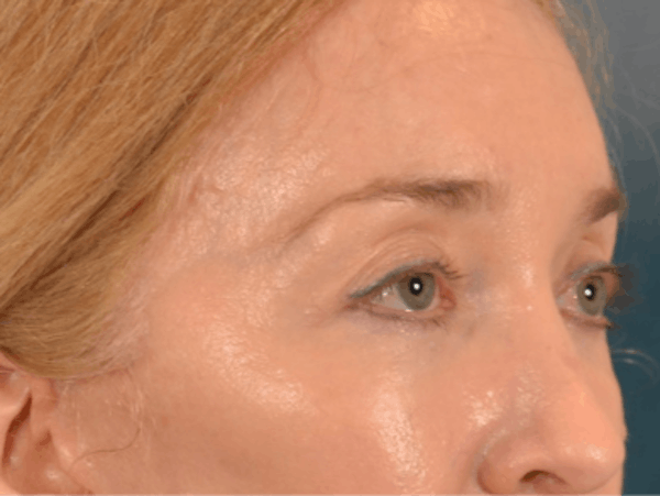 Eyelid Lift Before & After Gallery - Patient 120561 - Image 4