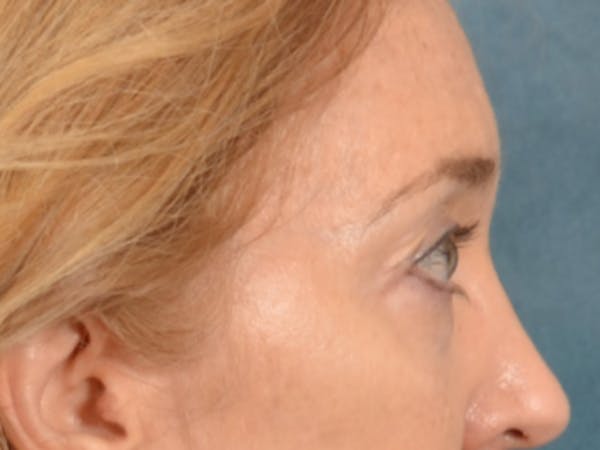Eyelid Lift Before & After Gallery - Patient 120561 - Image 5