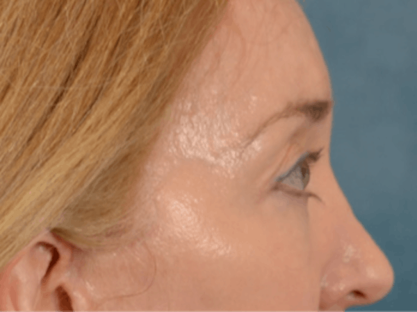 Eyelid Lift Before & After Gallery - Patient 120561 - Image 6