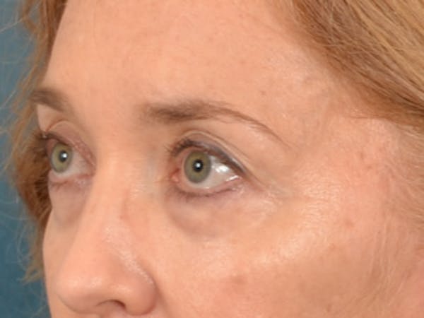Eyelid Lift Before & After Gallery - Patient 120561 - Image 7
