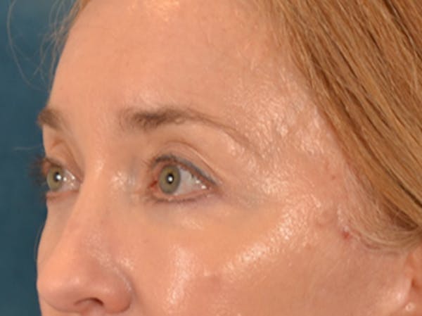 Eyelid Lift Before & After Gallery - Patient 120561 - Image 8