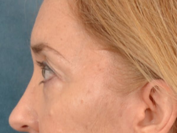 Eyelid Lift Before & After Gallery - Patient 120561 - Image 9