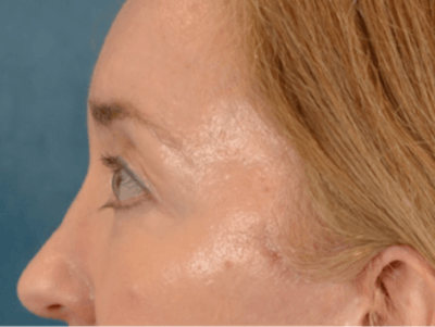 Eyelid Lift Before & After Gallery - Patient 120561 - Image 10