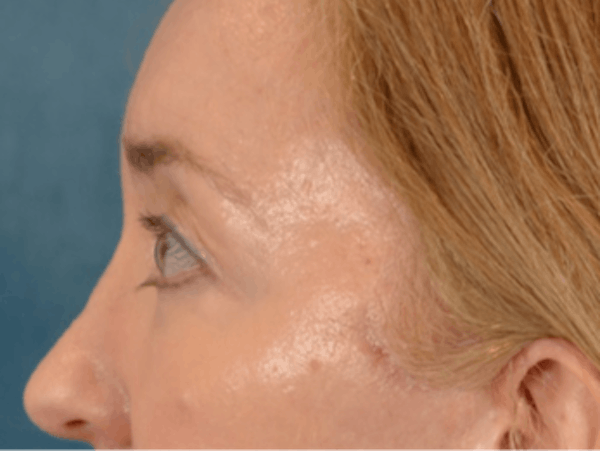 Eyelid Lift Before & After Gallery - Patient 120561 - Image 10