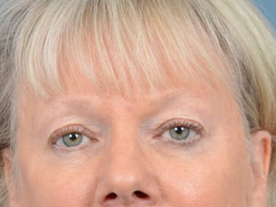 Eyelid Lift Before & After Gallery - Patient 146899107 - Image 1