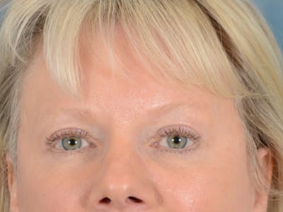 Eyelid Lift Before & After Gallery - Patient 146899107 - Image 2