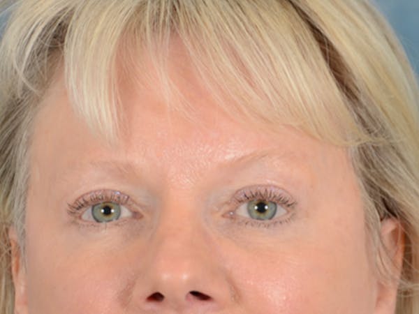 Eyelid Lift Before & After Gallery - Patient 146899107 - Image 2