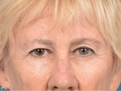 Eyelid Lift Before & After Gallery - Patient 146899004 - Image 1