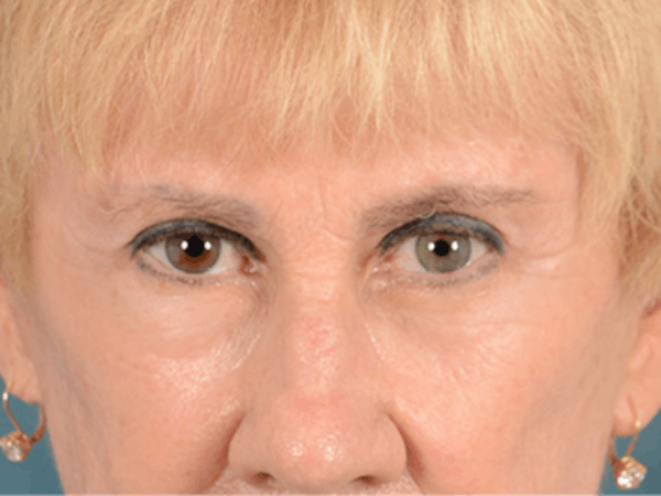 Eyelid Lift Before & After Gallery - Patient 146899004 - Image 2