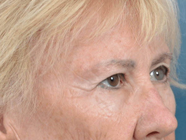 Eyelid Lift Before & After Gallery - Patient 146899004 - Image 3