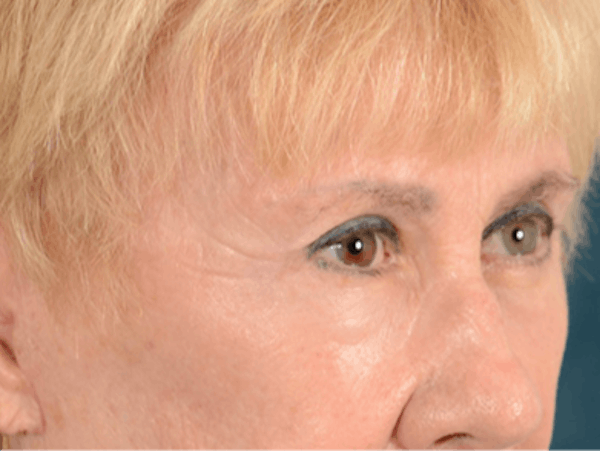 Eyelid Lift Before & After Gallery - Patient 146899004 - Image 4