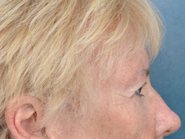 Eyelid Lift Before & After Gallery - Patient 146899004 - Image 5