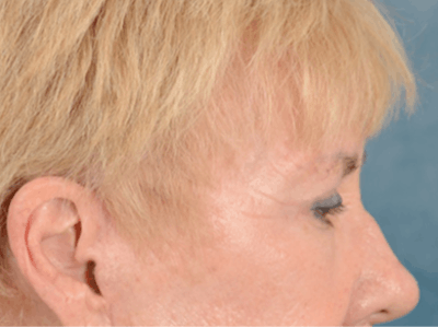 Eyelid Lift Before & After Gallery - Patient 146899004 - Image 6