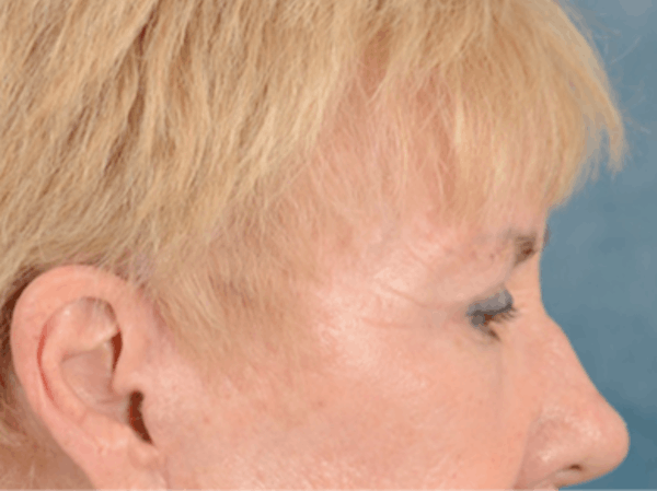 Eyelid Lift Before & After Gallery - Patient 146899004 - Image 6