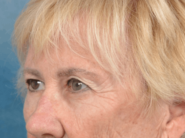 Eyelid Lift Before & After Gallery - Patient 146899004 - Image 7