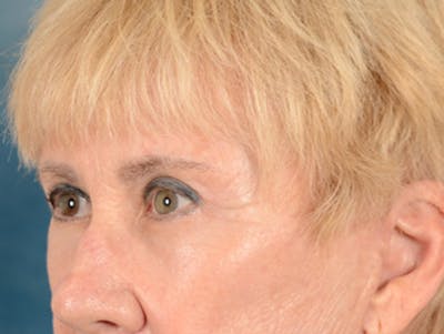 Eyelid Lift Before & After Gallery - Patient 146899004 - Image 8