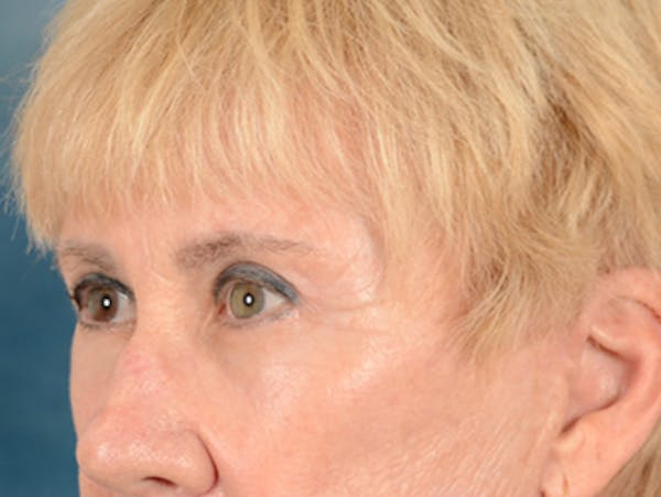 Eyelid Lift Before & After Gallery - Patient 146899004 - Image 8
