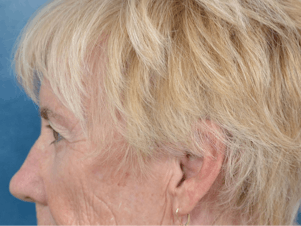 Eyelid Lift Before & After Gallery - Patient 146899004 - Image 9
