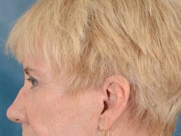 Eyelid Lift Before & After Gallery - Patient 146899004 - Image 10