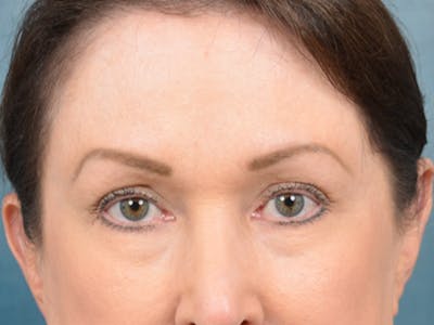 Eyelid Lift Before & After Gallery - Patient 146208664 - Image 1