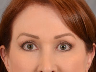 Eyelid Lift Before & After Gallery - Patient 146208664 - Image 2