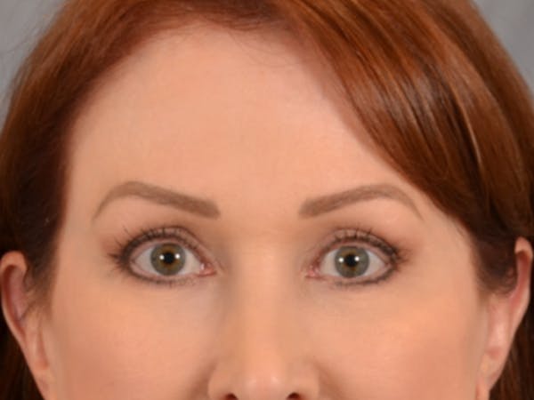 Eyelid Lift Before & After Gallery - Patient 146208664 - Image 2