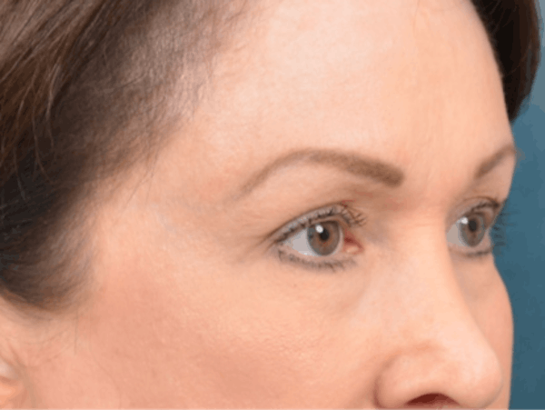 Eyelid Lift Before & After Gallery - Patient 146208664 - Image 3