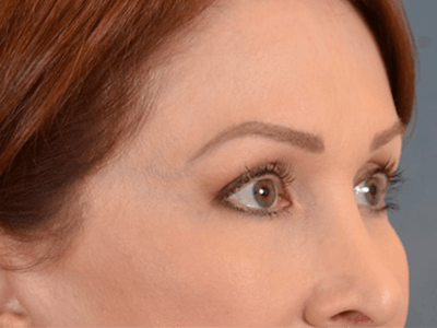 Eyelid Lift Before & After Gallery - Patient 146208664 - Image 4