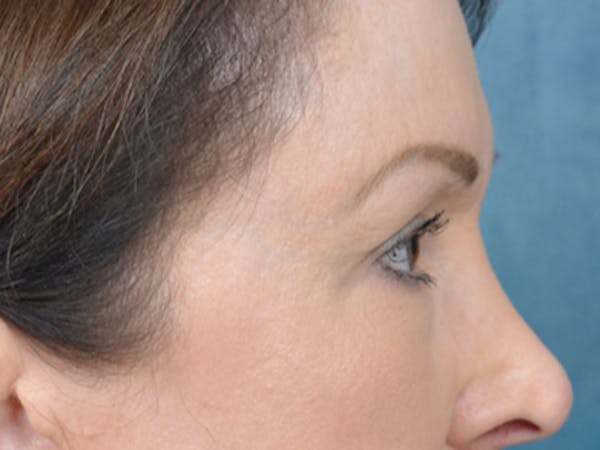 Eyelid Lift Before & After Gallery - Patient 146208664 - Image 5