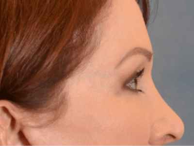 Eyelid Lift Before & After Gallery - Patient 146208664 - Image 6