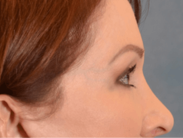 Eyelid Lift Before & After Gallery - Patient 146208664 - Image 6
