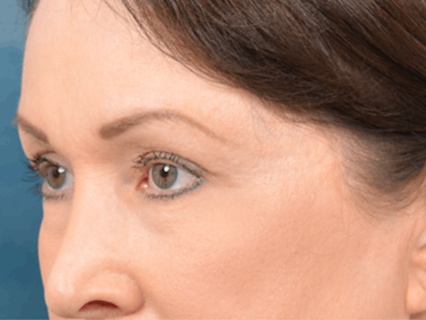 Eyelid Lift Before & After Gallery - Patient 146208664 - Image 7