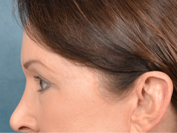 Eyelid Lift Before & After Gallery - Patient 146208664 - Image 9