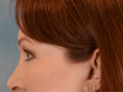 Eyelid Lift Before & After Gallery - Patient 146208664 - Image 10