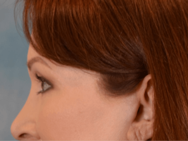 Eyelid Lift Before & After Gallery - Patient 146208664 - Image 10