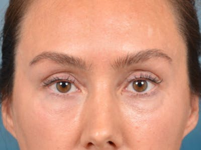 Eyelid Lift Before & After Gallery - Patient 146208591 - Image 1