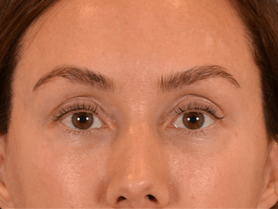 Eyelid Lift Before & After Gallery - Patient 146208591 - Image 2