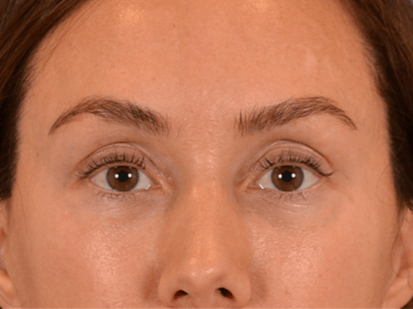 Eyelid Lift Before & After Gallery - Patient 146208591 - Image 2