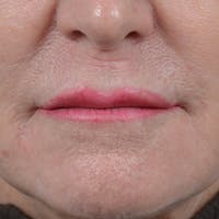 Lip Lift Before & After Gallery - Patient 16861941 - Image 1