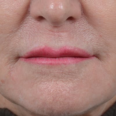 Lip Lift Before & After Gallery - Patient 16861941 - Image 1