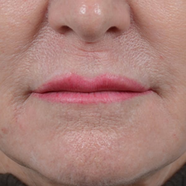 Lip Lift Before & After Gallery - Patient 16861941 - Image 1