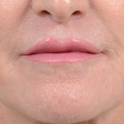 Lip Lift Before & After Gallery - Patient 16861941 - Image 2