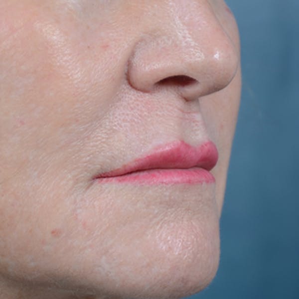 Lip Lift Before & After Gallery - Patient 16861941 - Image 3