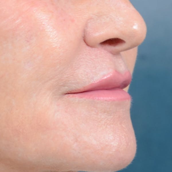Lip Lift Before & After Gallery - Patient 16861941 - Image 4